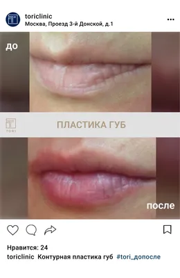 Губки до и после 1 мл #novacutan , #novacutanfbio, #новакутан,  #novacutanybio, #novacutansbio | Instagram