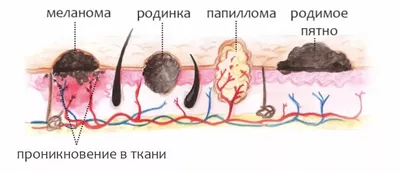 Диагностика и лечение новообразований кожи и подкожной клетчатки в  Краснодаре в клинике УРО-ПРО