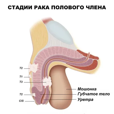 Гинеколог-онколог: нельзя игнорировать новообразования на половых органах -  Новый Калининград.Ru