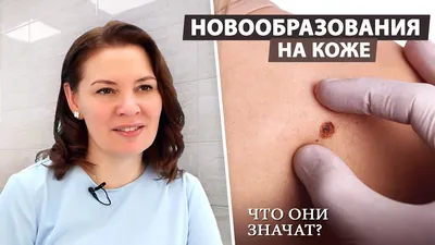 Новообразования, наросты и дефекты на коже: что делать и как лечить |  TopDoc.me Алматы