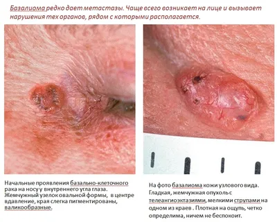 Книга «Меланоцитарные невусы и меланома кожи» — Курсы по дерматоскопии |  Юрий Сергеев