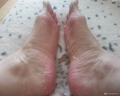 Маска-носки для ног Skinlite Exfoliating Foot Mask Отшелушивающая -  «Чудо-носки или как облезли ноги моего мужа)))))))) (фото результата)» |  отзывы