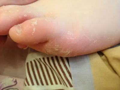Облазит кожа на ступняхи пальцах ног, не чешется, но побаливает - Вопрос  дерматологу - 03 Онлайн
