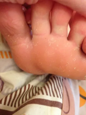 Облезает кожа на ладонях и стопах — 10 ответов | форум Babyblog