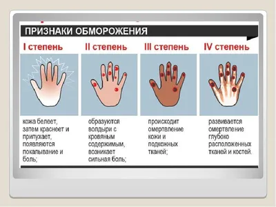 В чем разница между понятиями «обморожение» и «переохлаждение», объяснил  эксперт