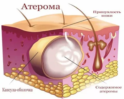 Пигментные образования кожи