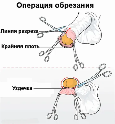 Обрезание: «плюсы» и «минусы». Мужское здоровье