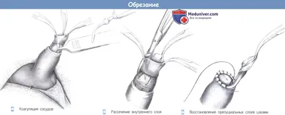 Обрезание у мужчин: зачем и нужно ли?