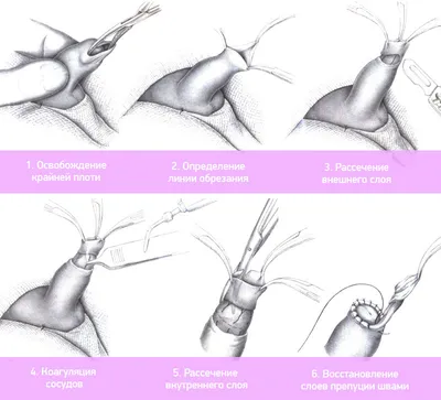 Как делают обрезание крайней плоти: виды операций - Медицинский центр  \"Допомога+\"
