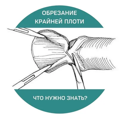 Опубликована карта популярности мужского обрезания в мире - МК