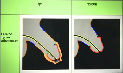 Интимная пластика у мужчин