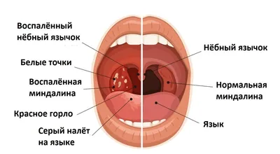 ПРОБКИ В ГОРЛЕ. Почему возникают пробки в миндалинах - YouTube