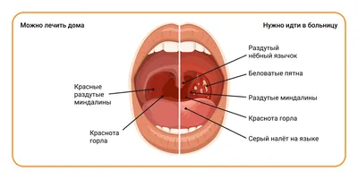 Гнойная ангина, чем лечить гнойную ангину, симптомы и признаки - блог  Furasol®