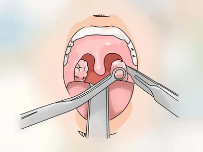 Как лечить хронический и острый тонзиллит: симптомы и препараты для  взрослых и детей