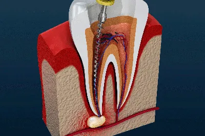 Удаление зубного нерва: показания и описание процедуры - Стомус