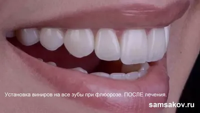 1️⃣ Удаление нерва зуба Алматы | Клиника «Dental Center»