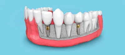 1️⃣ Коронки зубов Алматы | Клиника «Dental Center»