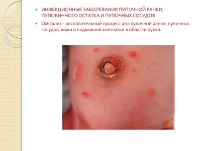 Омфалит новорожденных - презентация онлайн