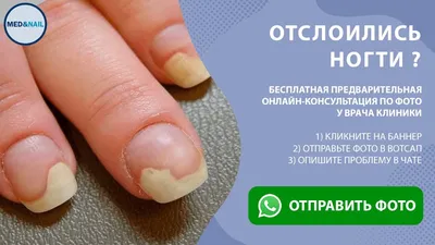 Онихолизис ногтей: виды, лечение, рекомендации