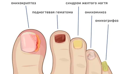 ➡️ Онихомикоз. Причины и лечение онихомикозов , лечение в Москве - Девита  (Devita)