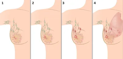 Рак груди :: ДНК-клиника
