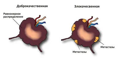 Рак молочной железы