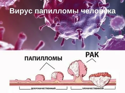 Удаление папиллом - Бушуев Семен Дмитриевич