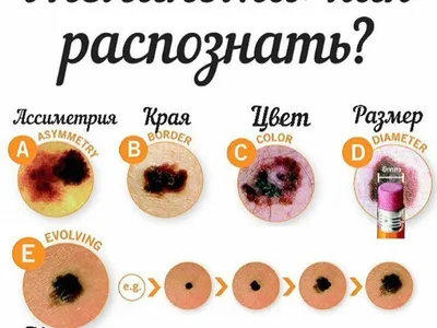 Родинки: появление на теле и на лице, почему растут, лечение, профилактика