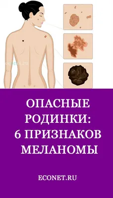 Родимое пятно: что это и можно ли его удалять | МЦ Лазерсвiт