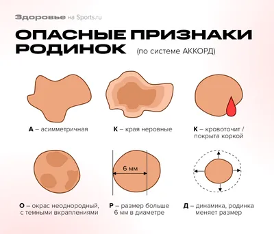 Опасные родинки: признаки злокачественных родинок, фото — MLC