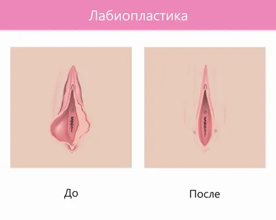 Операция на половую губу до и после фото
