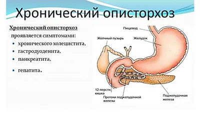 Описторхоз симптомы фото