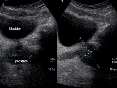 Холецистит (Cholecystitis) хронический и острый - симптомы и лечение у  женщин и мужчин, причины и диагностика заболевания, какой врач лечит,  анализы