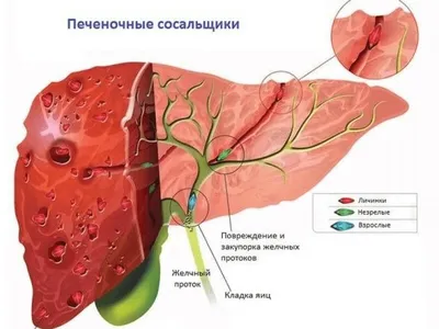 Описторхоз | Все о печени | Дзен