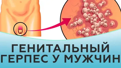 Герпес: причины, симптомы, диагностика, профилактика и лечение герпеса всех  видов в Москве - сеть клиник «Ниармедик»