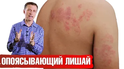 Опоясывающий герпес. | Клуб Успешных Врачей | Дзен