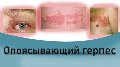 Опоясывающий герпес — Derma.ua