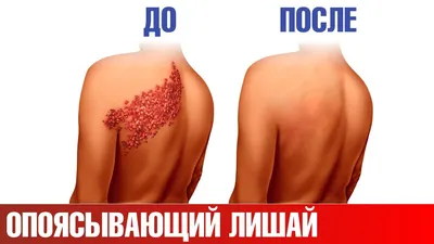 VITAMED MEDICAL - an affiliated branch of Medanta - Опоясывающий лишай  (герпетический ганглионит). Арифджанов Шухрат Хамиджонович –  врач-невропатолог высшей категории, кандидат медицинских наук, старший  научный сотрудник расскажет нам что же является ...