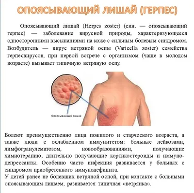 Опоясывающий лишай | vsevrachizdes.ru | Дзен