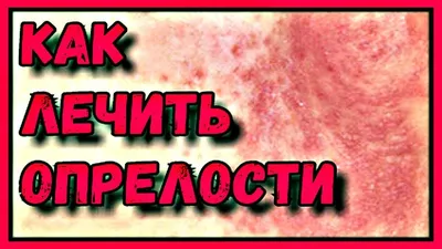 Опрелости у детей | Детский доктор | Дзен