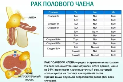 Глансэктомия при раке полового члена с реконструкцией головки уретральным  лоскутом и последующей лигаментотомией | UroWeb.ru — Урологический  информационный портал!