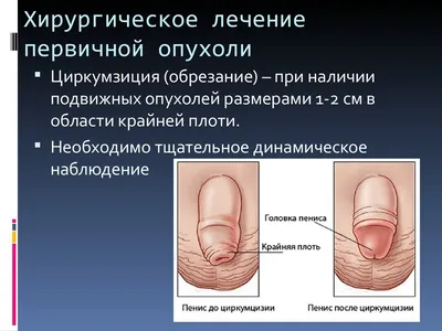 Удаление пупочной грыжи – «Dekamedical» Клиника в Москве.