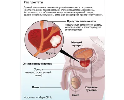 Удаление кондилом в Москве - Damas Medical Center