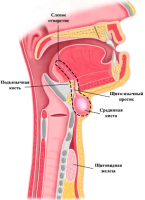 БОКОВАЯ КИСТА ШЕИ лечение в Харькове PHD.MD.KARCHINSKYI - Dr.ENT