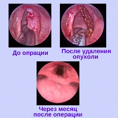 Шишка на шее. Щитовидная железа, опухоли кисти и другие причины