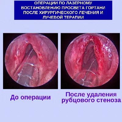 Нижегородские хирурги удалили редкую опухоль шеи 59-летнему пациенту |  Открытый Нижний