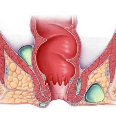 Полипы при геморрое - причины, симптомы, диагностика, лечение
