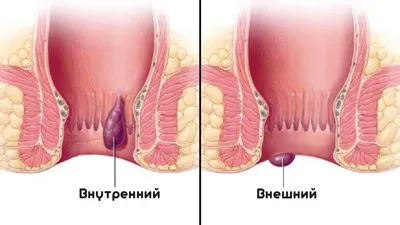 Опухоль в заднем проходе фото