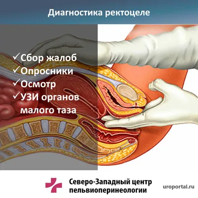 Острый парапроктит — (клиники Di Центр)