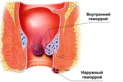 Полипы кишечника при геморрое - Проктология, заболевания